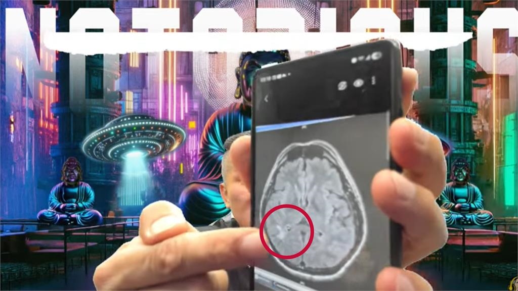 館長直播曬X光片自曝「腦有問題」！這1部分消失「驚見白色塊狀物」險癱瘓