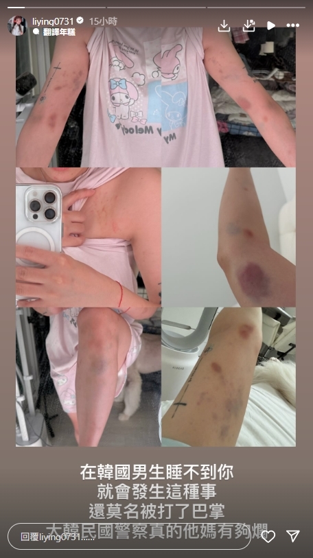 台灣46萬YTR「拒絕陪睡」遭韓國人當街暴打!全身瘀青、骨折傷勢照曝光