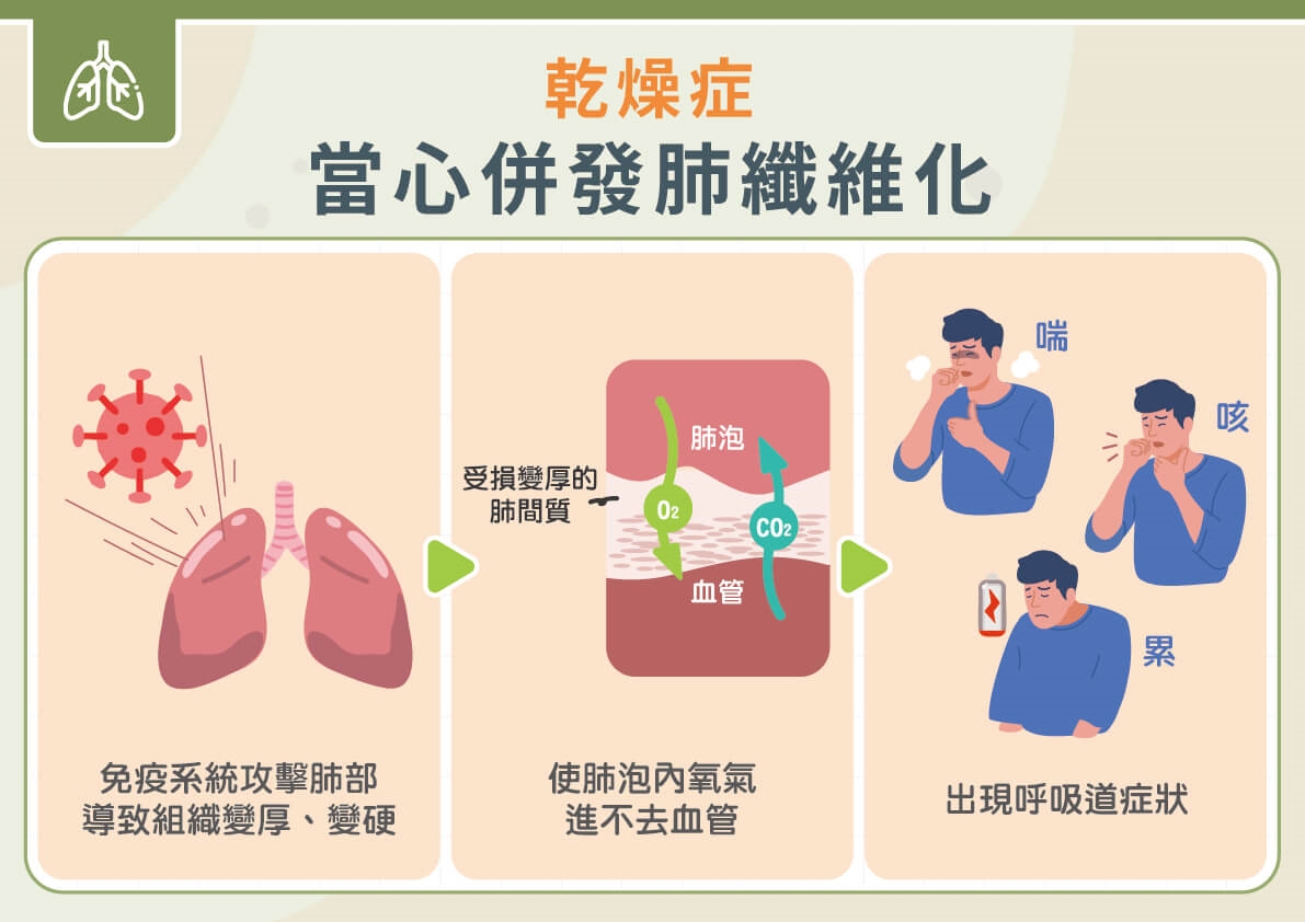 乾燥症悄悄傷肺！醫籲肺功能別等「咳、喘、累」才檢查