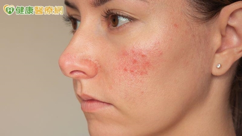 喝酒會加重酒糟鼻的症狀嗎？