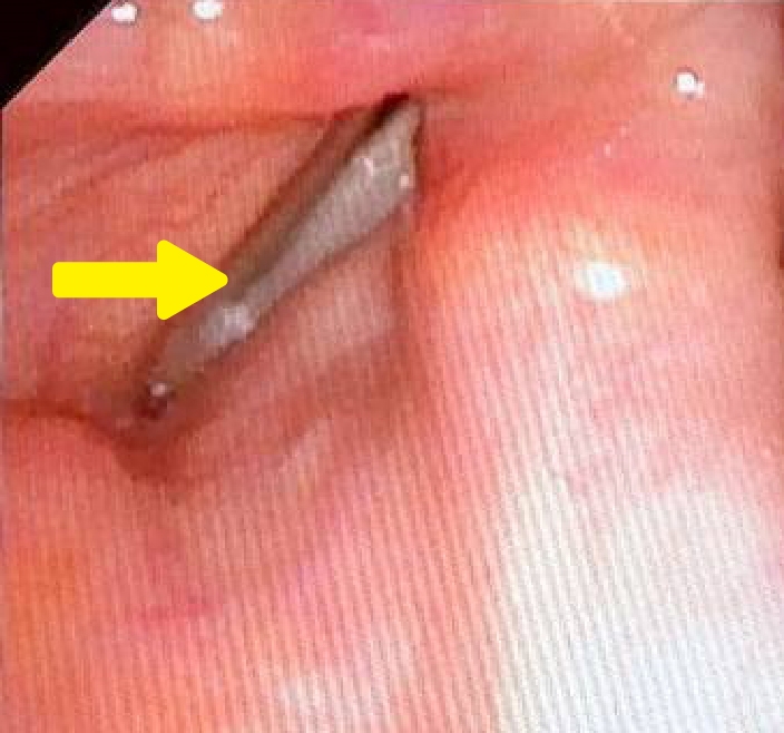 講話沙啞、嗆咳頻頻?!「單側聲帶麻痺」患者找回「新聲」有解方