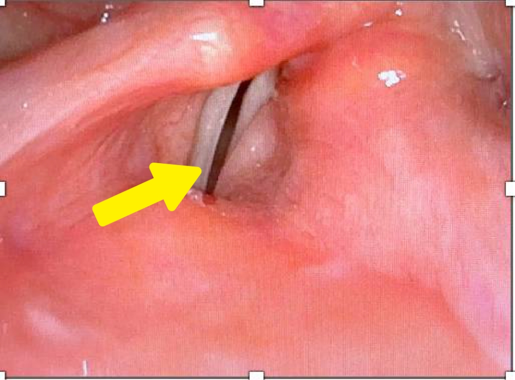 講話沙啞、嗆咳頻頻?!「單側聲帶麻痺」患者找回「新聲」有解方