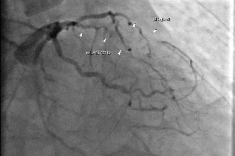 57歲男心臟衰竭顯喪命 醫：心臟支架手術後勿自行停藥