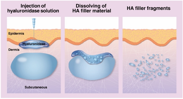 玻尿酸失敗怎麼辦？打降解酶會越溶越凹嗎？醫師指出「這兩點」最關鍵