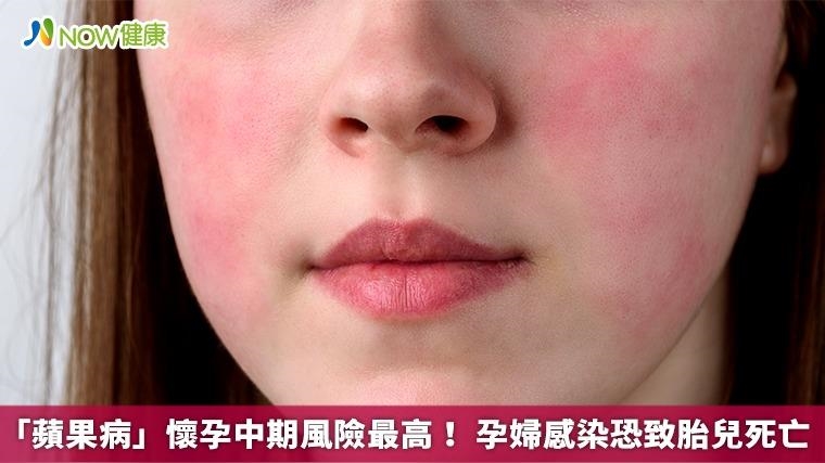 「蘋果病」懷孕中期風險最高！ 孕婦感染恐致胎兒死亡
