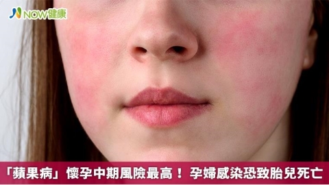 「蘋果病」懷孕中期風險最高！ 孕婦感染恐致胎兒死亡