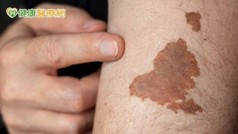 常誤以為只是痣！醫揭「最常見皮膚癌」警訊　這時應立即就醫