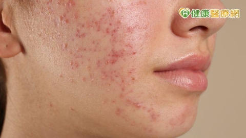 開學遇上滿臉痘痘不敢見同學?醫師教你和孩子如何對抗惱人青春痘
