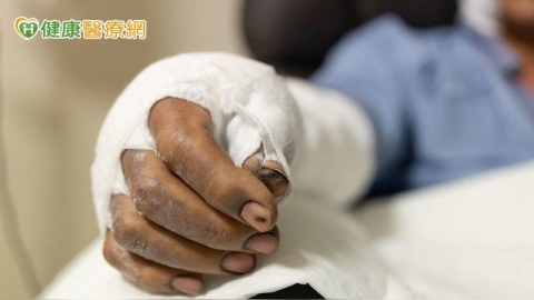 從全身47%燒傷到重返工作 30年鋼鐵師傅畫出復健力量