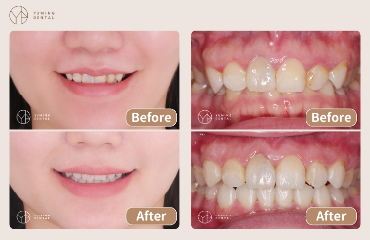 矯正是美好旅程！ 隱形矯正帶來3大效益綻放自信笑容