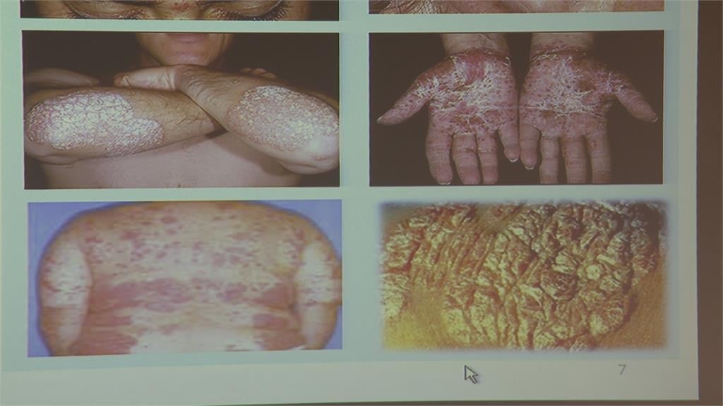 「糖尿病患者」罹患「帶狀疱疹」風險高 醫師:接種疫苗可預防