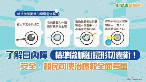 了解白內障「精準微脈衝環形切囊術」！　安全、親民可使治療較全面考量