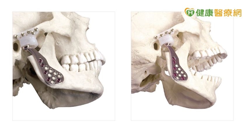 臉痛、張口困難?顳顎關節障礙原因多元 「新技術重建」改善生活困擾