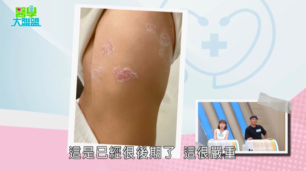 畇二熬夜到天亮竟染「皮蛇」!醫揭「這事」太少恐釀壓力荷爾蒙飆升！