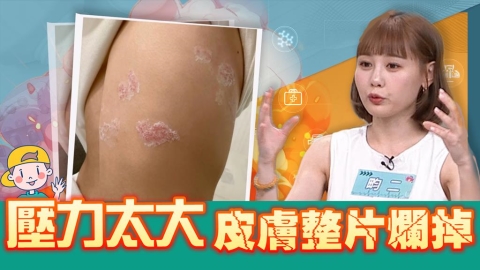 畇二熬夜到天亮竟染「皮蛇」!醫揭「這事」太少恐釀壓力荷爾蒙飆升!