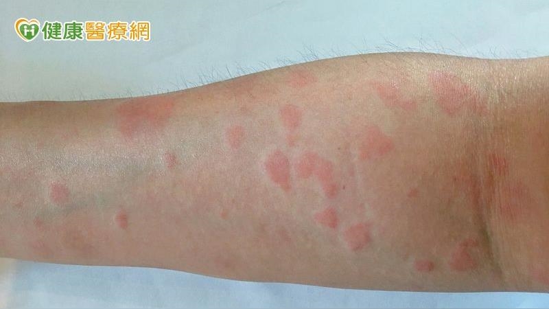 全身性紅斑性狼瘡病因複雜　生物製劑提升治療精準度