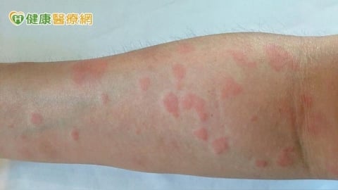 全身性紅斑性狼瘡病因複雜 生物製劑提升治療精準度