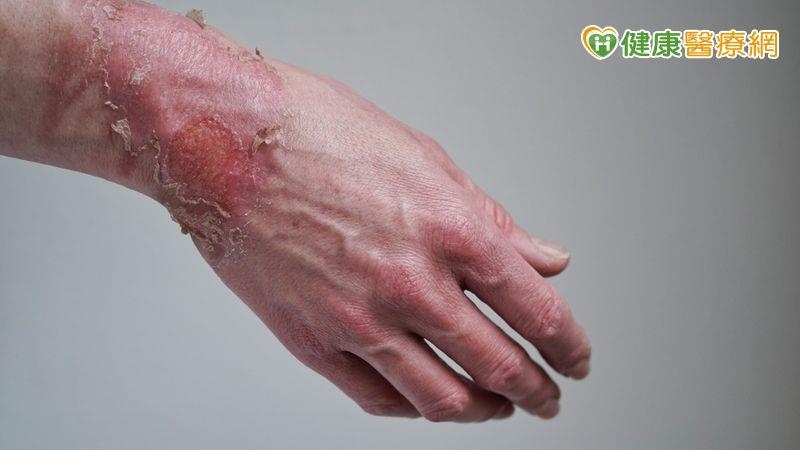 國際研究：燒燙傷後11天內植皮　減少併發症風險、總住院時間