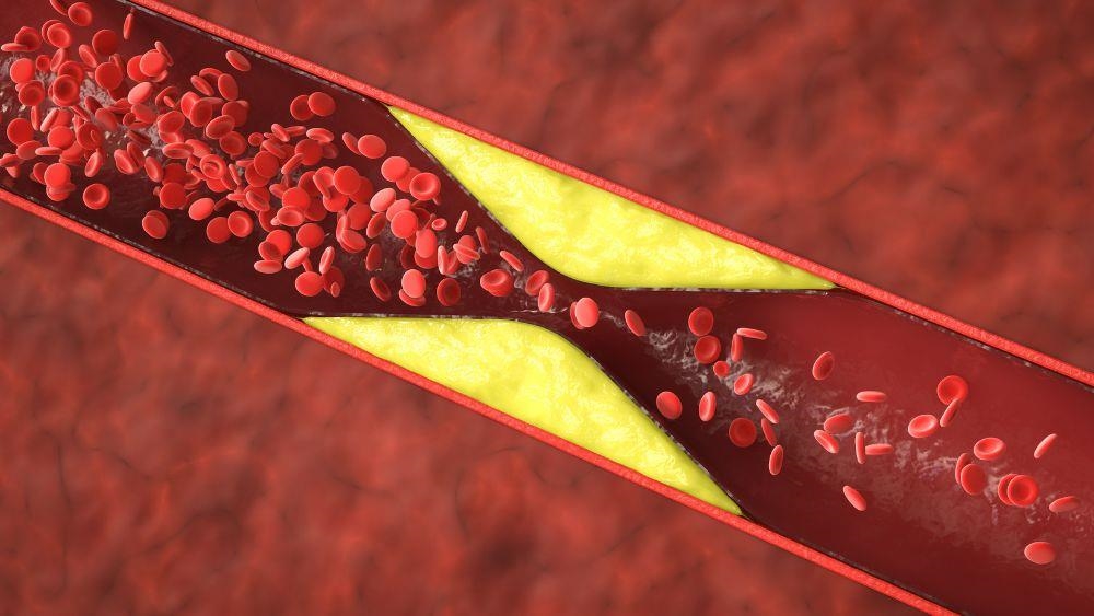 「血栓＝隱形殺手」！5大高危族群、症狀與預防重點一次看懂