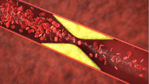 「血栓=隱形殺手」!5大高危族群、症狀與預防重點一次看懂