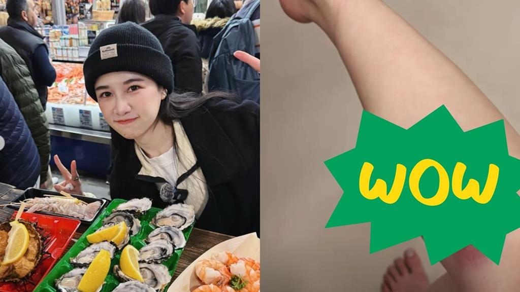 百萬YTR千千曬「大片瘀青照」嚇壞粉絲！「受傷原因曝光」她笑：我的膝蓋好硬