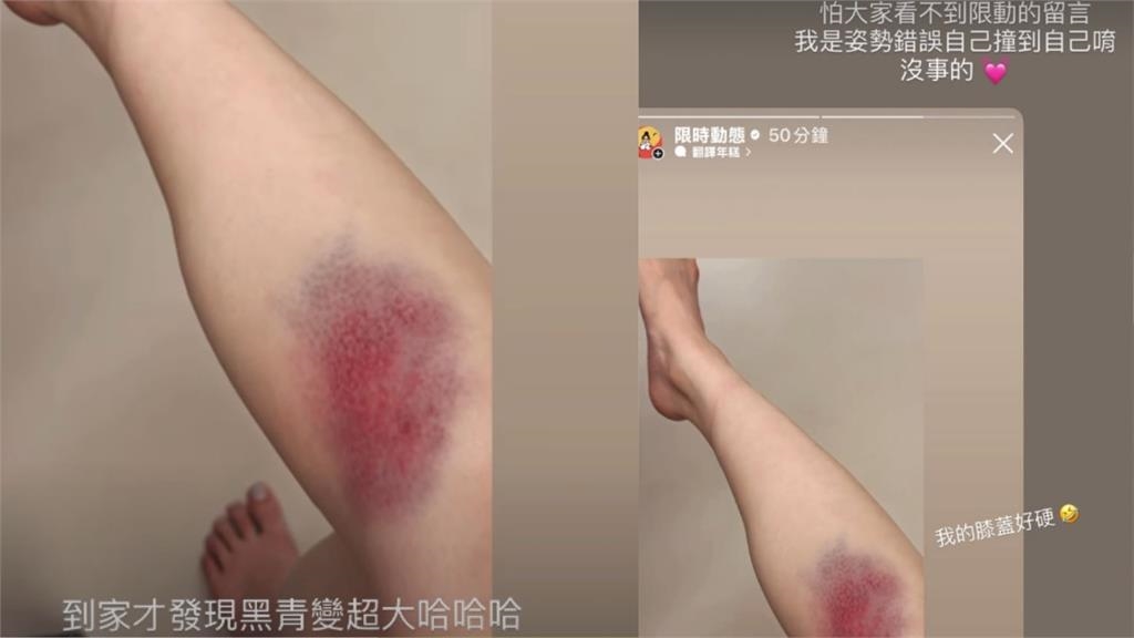 百萬YTR千千曬「大片瘀青照」嚇壞粉絲！「受傷原因曝光」她笑：我的膝蓋好硬