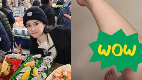 百萬YTR千千曬「大片瘀青照」嚇壞粉絲！「受傷原因曝光」她笑：我的膝蓋好硬