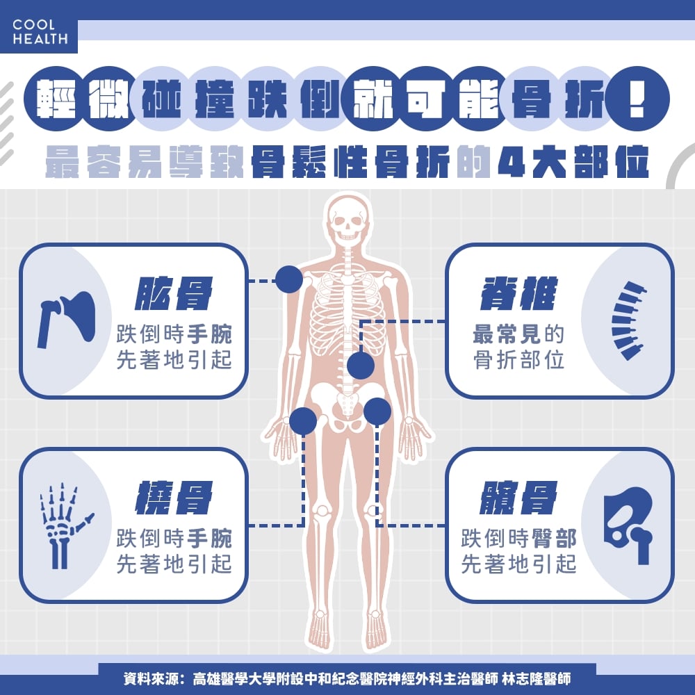 台灣50歲以上每4人有1人曾嚴重骨折，您正面臨骨鬆危險？  醫籲：及早做3件事預防