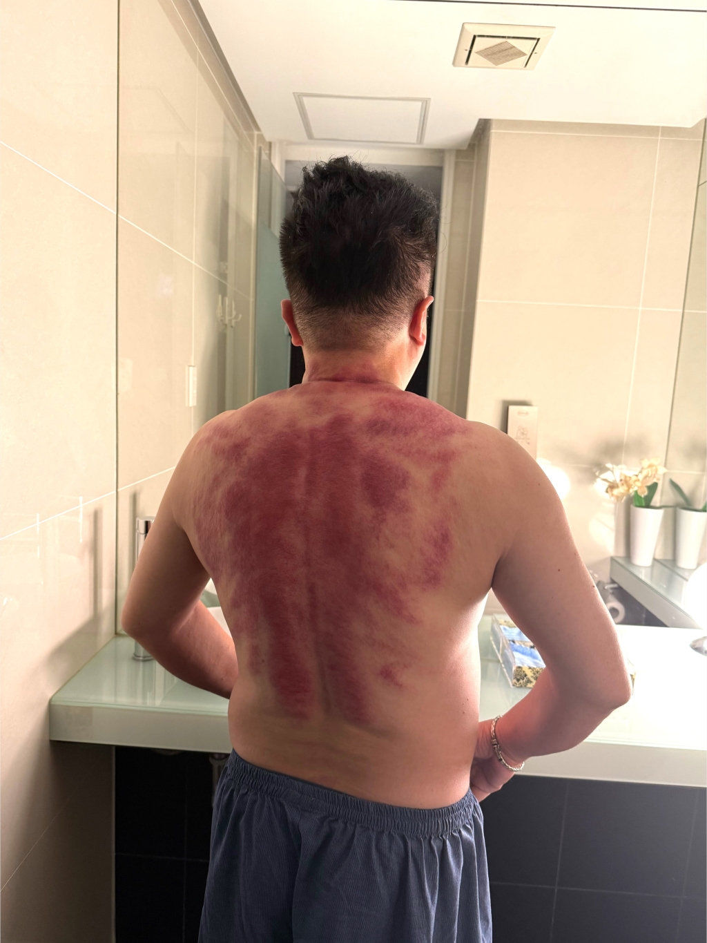 董至成猛曬10小時太陽！錄外景驚覺全身「脫一層皮」曝慘況：2天不能走路