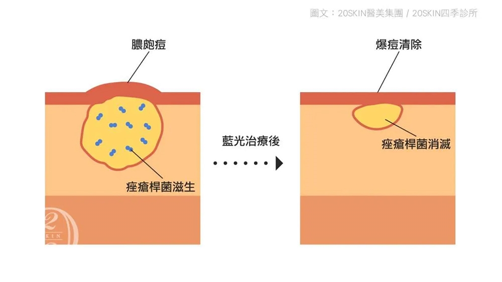 青春痘新知:藍光光照療法如何協助改善膚況