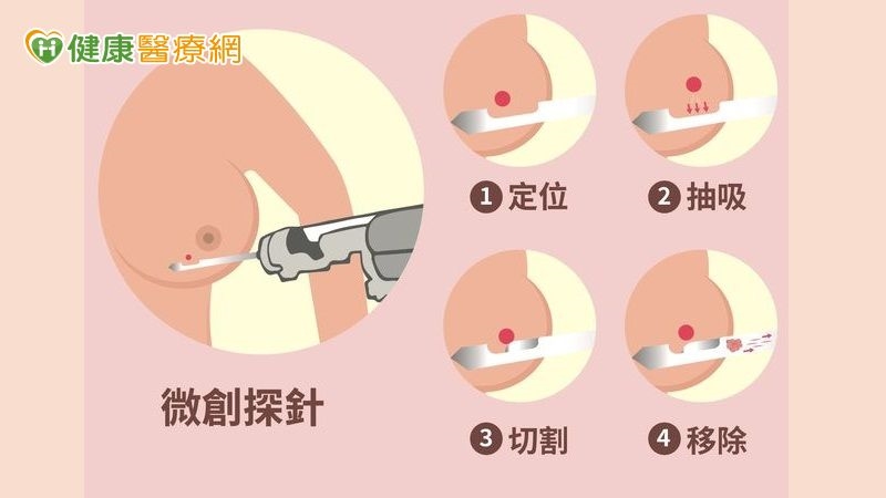 乳房腫瘤4種情況該切除!醫解析「微創手術適應症與優勢」