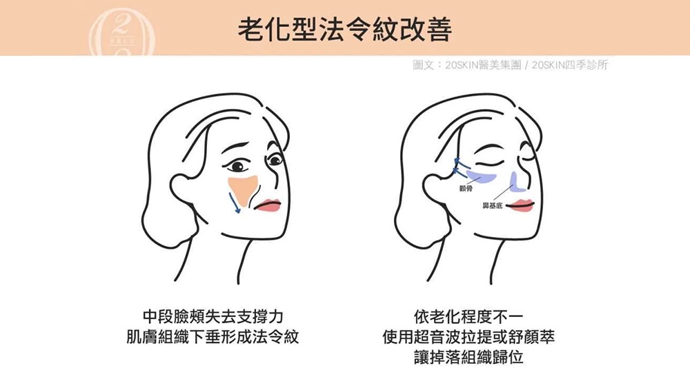 法令紋改善關鍵是什麼？醫師解析不同成因怎麼選療程！