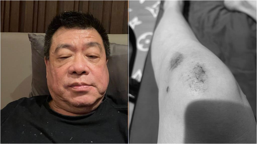 幫于朦朧發聲收死亡威脅　孫德榮突曬傷勢照曝「4天摔3次」：再跌恐上西天！