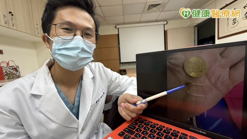 胸痛半天誤當心肌梗塞　竟是魚刺卡在食道裡