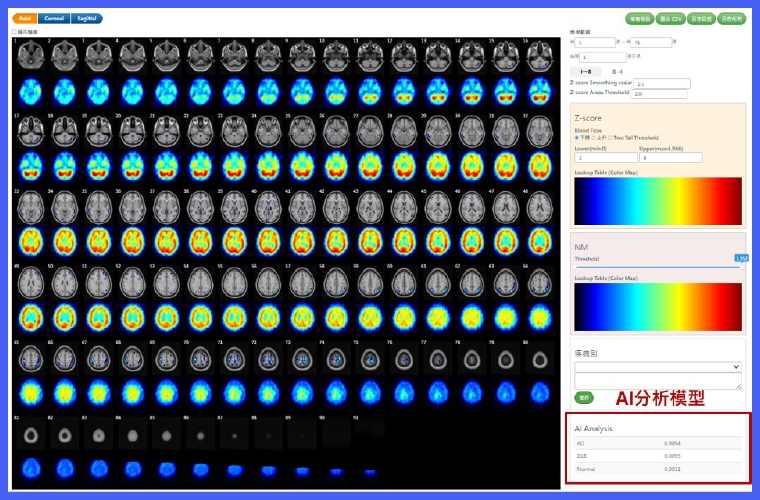 AI輔助識別早期失智症 亞東攜手國原院打造新智慧醫療