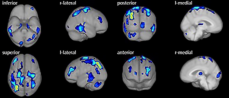 AI輔助識別早期失智症 亞東攜手國原院打造新智慧醫療