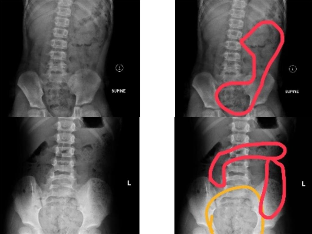 男童唇發紫送急診曝原因！照X光「這1物」塞到胸口