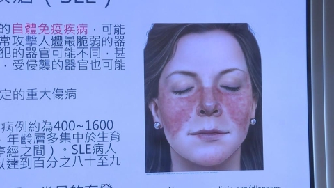 不只坣娜!港星周海媚也因罹患紅斑性狼瘡病逝