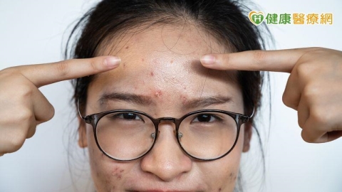 輕熟女滿臉痘? 「光動力治療」大幅改善症狀!