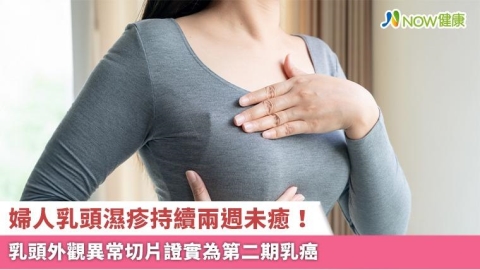婦人乳頭濕疹持續兩週未癒！ 乳頭外觀異常切片證實為第二期乳癌
