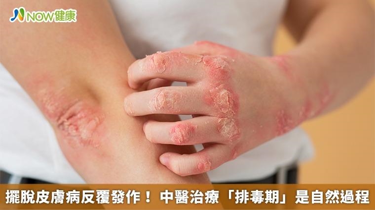 擺脫皮膚病反覆發作！ 中醫治療「排毒期」是自然過程