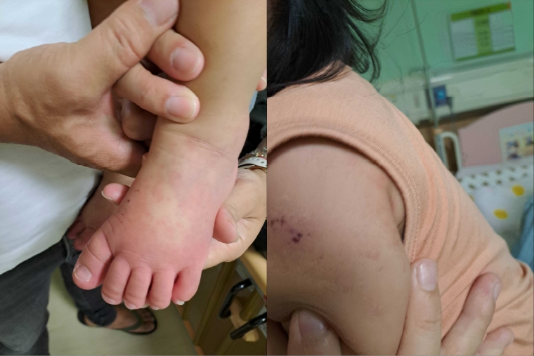 2歲童燒不停、手腳「腫得像麵龜」 原來是川崎病惹禍