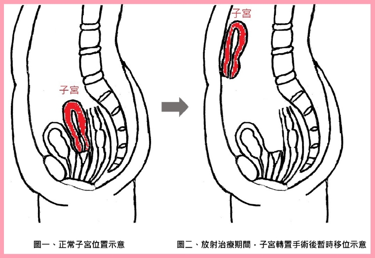  罕見技術！ 亞東全台首例「子宮轉置手術」登國際期刊