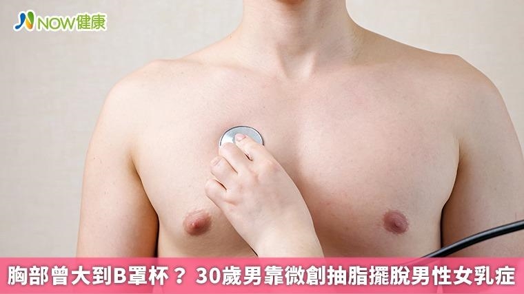 胸部曾大到B罩杯？ 30歲男靠微創抽脂擺脫男性女乳症