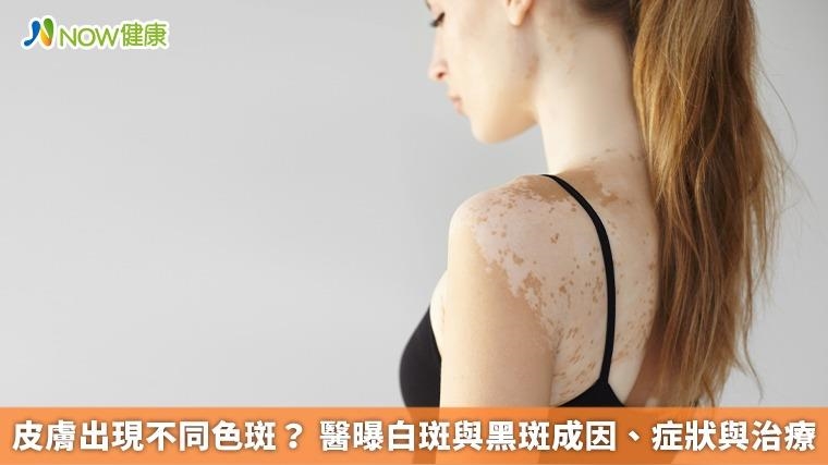 皮膚出現不同色斑？ 醫曝白斑與黑斑成因、症狀與治療
