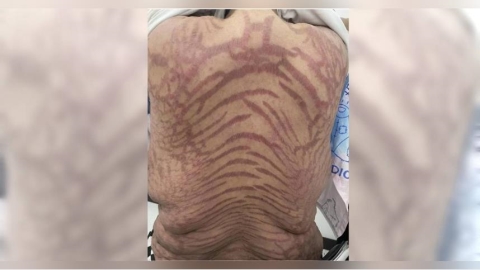 40歲女狂擦「萬能網紅神藥」全身冒紫紅斑紋　醫曝危險成分