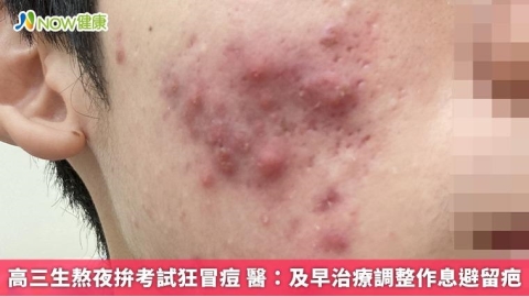 高三生熬夜拚考試狂冒痘 醫:及早治療調整作息避留疤