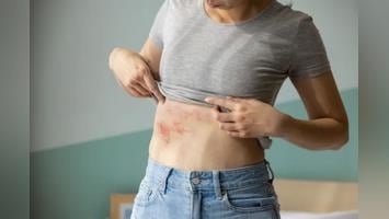 生活壓力大恐增皮蛇風險!? 新竹人請注意