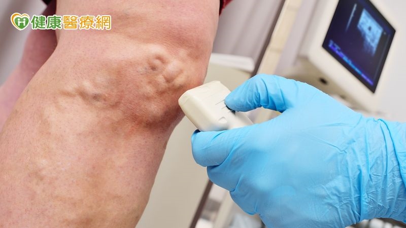 擔心靜脈曲張需手術!女教師暫別講台休息 新式治療助重執教鞭