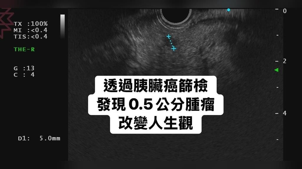 50歲男子健檢查出胰臟長腫瘤！嚇到做「這改變」脂肪肝、糖尿病都好轉